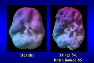 Healthy     At age 54,
          brain looked 85
 