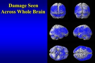 Damage Seen
Across Whole Brain
 