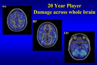 20 Year Player
Damage across whole brain
 
