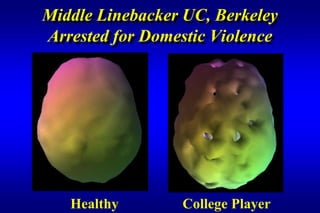 Middle Linebacker UC, Berkeley
Arrested for Domestic Violence




   Healthy       College Player
 
