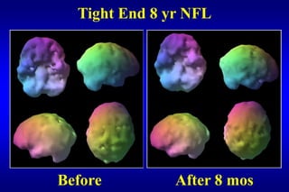 Tight End 8 yr NFL




Before         After 8 mos
 