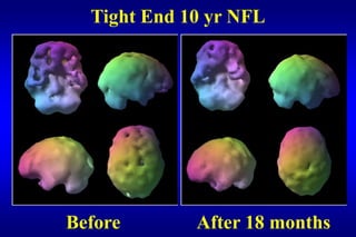 Tight End 10 yr NFL




Before       After 18 months
 
