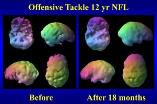 Offensive Tackle 12 yr NFL




Before         After 18 months
 