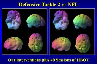 Defensive Tackle 2 yr NFL




Our interventions plus 40 Sessions of HBOT
 
