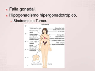 Falla gonadal.Hipogonadismo hipergonadotrópico.Síndrome de Turner. 