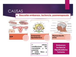 CAUSAS
Descartar embarazo, lactancia, posmenopausia
SOP
Amenorrea
hipotalamica
Hiperprolactin
emia
1° retraso
constitucional del
crecimiento y la
pubertad
2° estrés físico y
psicológico
Embarazo,
lactancia.
Hipotiroidismo
Tumores