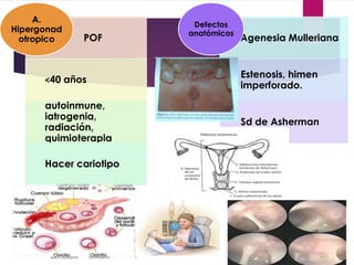 POF
˂40 años
autoinmune,
iatrogenia,
radiación,
quimioterapia
Hacer cariotipo
A.
Hipergonad
otropico Agenesia Mulleriana
Estenosis, himen
imperforado.
Sd de Asherman
Defectos
anatómicos
 