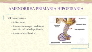 AMENORREA PRIMARIA HIPOFISARIA
Otras causas:
– infecciones,
– traumatismos que produzcan
sección del tallo hipofisario,
– tumores hipofisarios.
 