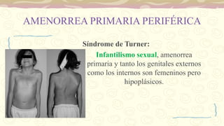 AMENORREA PRIMARIA PERIFÉRICA
Síndrome de Turner:
Infantilismo sexual, amenorrea
primaria y tanto los genitales externos
como los internos son femeninos pero
hipoplásicos.
 