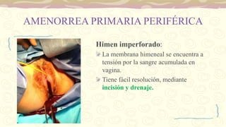 AMENORREA PRIMARIA PERIFÉRICA
Himen imperforado:
La membrana himeneal se encuentra a
tensión por la sangre acumulada en
vagina.
Tiene fácil resolución, mediante
incisión y drenaje.
 