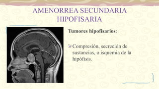 AMENORREA SECUNDARIA
HIPOFISARIA
Tumores hipofisarios:
Compresión, secreción de
sustancias, o isquemia de la
hipófisis.
 
