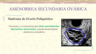 AMENORREA SECUNDARIA OVÁRICA
Síndrome de Ovario Poliquístico:
Frecuente, y se caracteriza por ciclos anovulatorios,
alteraciones menstruales y puede desencadenar
amenorrea secundaria.
 