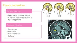 • Deriva de la bolsa de Rathke
• Cefaleas, pérdida de la visión e
hipoestrogenismo.
Craneofaringionma
• Sarcoidosis
• Histiocitosis
• Hemocromatosis
• Linfoma
Trastornos infiltrativos
Causas anatómicas:
 