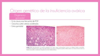 Origen genético de la insuficiencia ovárica
Disgenesia
gonadal
• Es la causa mas frecuente de POF
• Ovocitos sufren atresia acelerada
• Estria gonadal
 