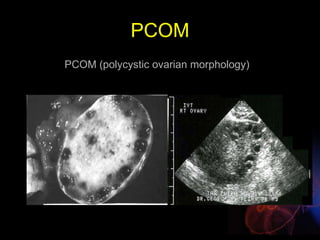 PCOM
PCOM (polycystic ovarian morphology)
 