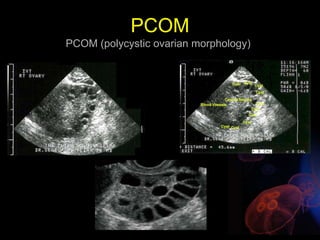 PCOM
PCOM (polycystic ovarian morphology)
 
