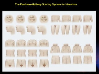 The Ferriman–Gallwey Scoring System for Hirsutism.
 
