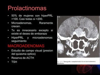 Prolactinomas
• 50% de mujeres con hiperPRL
>100. Casi todas si >200.
• Microadenomas. Raramente
crecen.
• Tx es innecesario excepto si
existe el deseo de embarazo
• HiperPRL y microadenomas:
seguimiento
MACROADENOMAS
• Estudio de campo visual (presion
del quiasma optico)
• Reserva de ACTH
• TSH
 