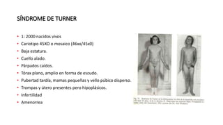 SÍNDROME DE TURNER
• 1: 2000 nacidos vivos
• Cariotipo 45XO o mosaico (46xx/45x0)
• Baja estatura.
• Cuello alado.
• Párpados caídos.
• Tórax plano, amplio en forma de escudo.
• Pubertad tardía, mamas pequeñas y vello púbico disperso.
• Trompas y útero presentes pero hipoplásicos.
• Infertilidad
• Amenorrea
 