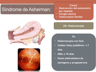 Síndrome de Asherman:
DX: Histeroscopia
Causa:
• Destrucción del endometrio
por raspado
• Cirugia uterina
• Tuberculosis Genital
TX:
• Histeroscopia con lisis
• Catéter foley pediátrico x 7
días
• ABtx x 10 días
• Dosis estimuladora de
estrógeno y progesterona
 
