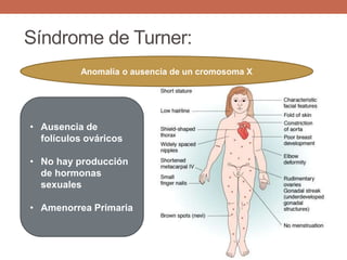 Síndrome de Turner:
Anomalía o ausencia de un cromosoma X
• Ausencia de
folículos ováricos
• No hay producción
de hormonas
sexuales
• Amenorrea Primaria
 