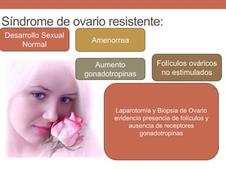 Síndrome de ovario resistente:
Desarrollo Sexual
Normal
Amenorrea
Aumento
gonadotropinas
Folículos ováricos
no estimulados
Laparotomía y Biopsia de Ovario
evidencia presencia de folículos y
ausencia de receptores
gonadotropinas
 