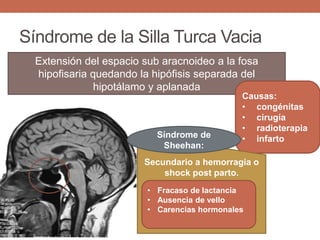 Síndrome de la Silla Turca Vacia
Extensión del espacio sub aracnoideo a la fosa
hipofisaria quedando la hipófisis separada del
hipotálamo y aplanada
Causas:
• congénitas
• cirugía
• radioterapia
• infarto
Secundario a hemorragia o
shock post parto.
Síndrome de
Sheehan:
• Fracaso de lactancia
• Ausencia de vello
• Carencias hormonales
 