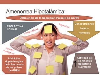Amenorrea Hipotalámica:
Deficiencia de la Secreción Pulsátil de GnRH
Gonadotropinas
bajas o
normales
PROLACTINA
NORMAL
Actividad del
eje hipofisis
hipotalamo-
suprarenal
Inhibición
dopaminergica
de la frecuencia
de los pulsos
de GNRH
 