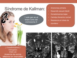 Síndrome de Kallman: • Amenorrea primaria
• Desarrollo sexual infantil
• Gonadotropinas bajas
• Cariotipo femenino normal
• Resistencia al citrato de
clomifeno
↓ Gonadotropinas y
Estrogenos
FSH>LH
Ausencia de surcos
olfatorios en rinencefalo
1 solo gen en el
brazo corto del
cromosoma X
 