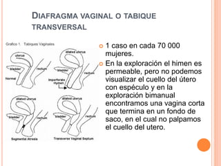 DIAFRAGMA VAGINAL O TABIQUE 
TRANSVERSAL 
 1 caso en cada 70 000 
mujeres. 
 En la exploración el himen es 
permeable, pero no podemos 
visualizar el cuello del útero 
con espéculo y en la 
exploración bimanual 
encontramos una vagina corta 
que termina en un fondo de 
saco, en el cual no palpamos 
el cuello del utero. 
 