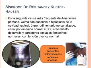 SÍNDROME DE ROKITANSKY KUSTER-HAUSER 
 Es la segunda causa más frecuente de Amenorrea 
primaria. Cursa con ausencia o hipoplasia de la 
cavidad vaginal, útero rudimentario no canalizado, 
cariotipo femenino normal 46XX, crecimiento, 
desarrollo y caracteres sexuales femeninos 
normales, con función ovárica normal. 
Presenta 
frecuentes 
malformaciones 
renales o 
urinarias. 
 