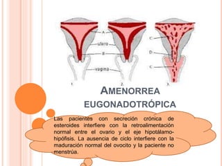 AMENORREA 
EUGONADOTRÓPICA 
Las pacientes con secreción crónica de 
esteroides interfiere con la retroalimentación 
normal entre el ovario y el eje hipotálamo-hipófisis. 
La ausencia de ciclo interfiere con la 
maduración normal del ovocito y la paciente no 
menstrúa. 
 