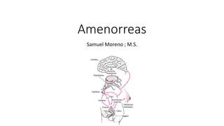 Amenorreas
Samuel Moreno ; M.S.
 