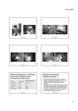 04.11.2014 
5 
www.yoldemir.com www.yoldemir.com 
www.yoldemir.com www.yoldemir.com 
DDiiffffeerreennttiiaall DDiiaaggnnoossiiss ooff phheennoottyyppiicc 
FFeemmaallee wwiitthh seeccoonnddaarryy SSeexxuuaall 
DDeevveellooppmmeenntt aanndd NNoo UUtteerruuss 
www.yoldemir.com 
DDeeffeeccttss ooff tthhee ffeemmaallee 
rreepprroodduuccttiivvee ttrraacctt -4 
• Reepprroodduuccttiivvee ttrraacctt ddeeffeeccttss mmaayy bbee dduuee ttoo iiaattrrooggeenniicc 
ccaauusseess,, ssuucchh aass ssccaarrrriinngg aanndd sstteennoossiiss ooff tthhee cceerrvviixx aafftteerr 
ddiillaattiioonn aanndd ccuurreettttaaggee,, ccoonniizzaattiioonn, llaasseerr,, oorr lloooopp 
eelleeccttrroossuurrggiiccaall eexxcciissiioonn pprroocceedduurreess ttoo ttrreeaatt cceerrvviiccaall 
ddyyssppllaassiiaa.. 
• DDeessttrruuccttiioonn ooff tthhee eennddoommeettrriiuumm aafftteerr aa vviiggoorroouuss ccuurreettttaaggee 
aafftteerr ppoossttppaarrttuumm hheemmoorrrrhhaaggee oorr tthheerraappeeuuttiicc aabboorrttiioonn oorr 
aafftteerr iinnffeeccttiioonn aassssoocciiaatteedd wwiitthh aa mmiisssseedd aabboorrttiioonn rreessuullttss iinn 
ssccaarr ttiissssuuee oorr uutteerriinnee ssyynneecchhiiaaee (AAsshheerrmmaann’’ss ssyynnddrroommee).. 
• TThhee ddiiaaggnnoossiiss ooff tthhiiss ddeeffeecctt iiss rraarree iinn tthhee aabbsseennccee ooff aa 
pprreevviioouuss ssuurrggiiccaall pprroocceedduurree oorr pprreeggnnaannccyy.. 
www.yoldemir.com 
 