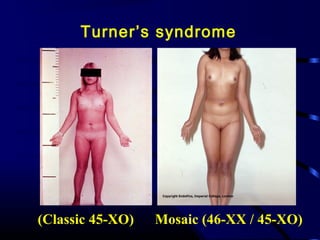 Mosaic (46-XX / 45-XO((Classic 45-XO(
Turner’s syndrome
 