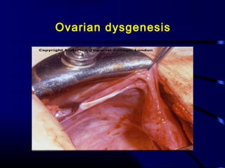 Ovarian dysgenesis
 