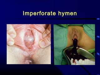 Imperforate hymen
 