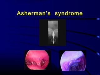 Asherman’s syndrome
 
