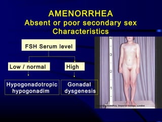 FSH Serum level
Low / normal High
Hypogonadotropic
hypogonadim
Gonadal
dysgenesis
AMENORRHEA
Absent or poor secondary sex
Characteristics
 