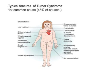 Typical features of Turner Syndrome
1st common cause (45% of causes )
 
