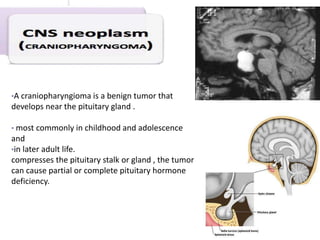 •A craniopharyngioma is a benign tumor that
develops near the pituitary gland .
• most commonly in childhood and adolescence
and
•in later adult life.
compresses the pituitary stalk or gland , the tumor
can cause partial or complete pituitary hormone
deficiency.
 