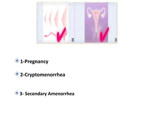 ✴1-Pregnancy
✴2-Cryptomenorrhea :
imperforated hymen, vaginal septum,
✴3- Secondary Amenorrhea :
hypothalamic, pituitary ,other endocrionpathy
 