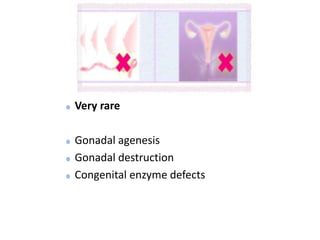 Very rare
Gonadal agenesis
Gonadal destruction
Congenital enzyme defects
 