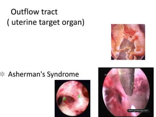 Outflow tract
( uterine target organ)
Asherman's Syndrome
 