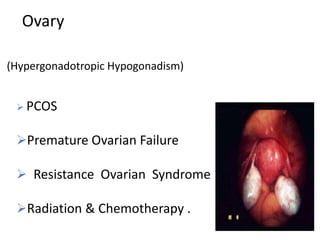 Ovary
 PCOS
Premature Ovarian Failure
 Resistance Ovarian Syndrome
Radiation & Chemotherapy .
(Hypergonadotropic Hypogonadism)
 
