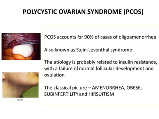 POLYCYSTIC OVARIAN SYNDROME (PCOS)
PCOS accounts for 90% of cases of oligoamenorrhea
Also known as Stein-Leventhal syndrome
The etiology is probably related to insulin resistance,
with a failure of normal follicular development and
ovulation
The classical picture – AMENORRHEA, OBESE,
SUBINFERTILITY and HIRSUITISM
 