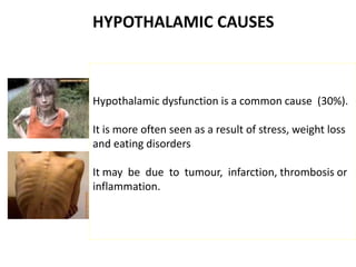 HYPOTHALAMIC CAUSES
Hypothalamic dysfunction is a common cause (30%).
It is more often seen as a result of stress, weight loss
and eating disorders
It may be due to tumour, infarction, thrombosis or
inflammation.
 