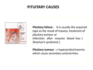 Pituitary failure - It is usually the acquired
type as the result of trauma, treatment of
pituitary tumour or
infarction after massive blood loss (
Sheehan’s syndrome )
Pituitary tumour  hyperprolactinaemia
which cause secondary amenorrhea.
PITUITARY CAUSES
 