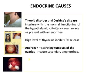 ENDOCRINE CAUSES
Thyroid disorder and Cushing’s disease
interfere with the normal functioning of
the hypothalamic -pituitary – ovarian axis
 present with amenorrhea.
High level of thyroxine inhibit FSH release.
Androgen – secreting tumours of the
ovaries  cause secondary amenorrhea.
 