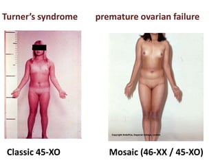 Classic 45-XO Mosaic (46-XX / 45-XO)
Turner’s syndrome premature ovarian failure
 